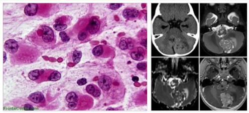 Atypical teratoid and rhabdoid tumor